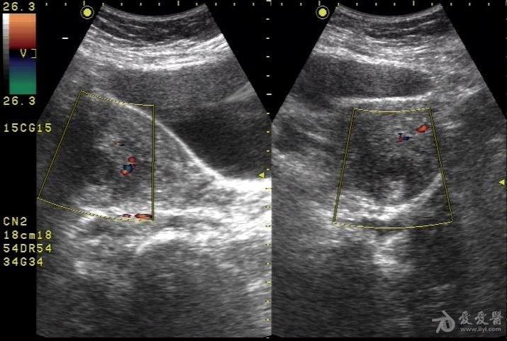子宫肌瘤变性超声图片图片