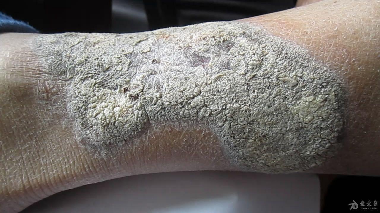 胸腺瘤术后下肢皮肤病变