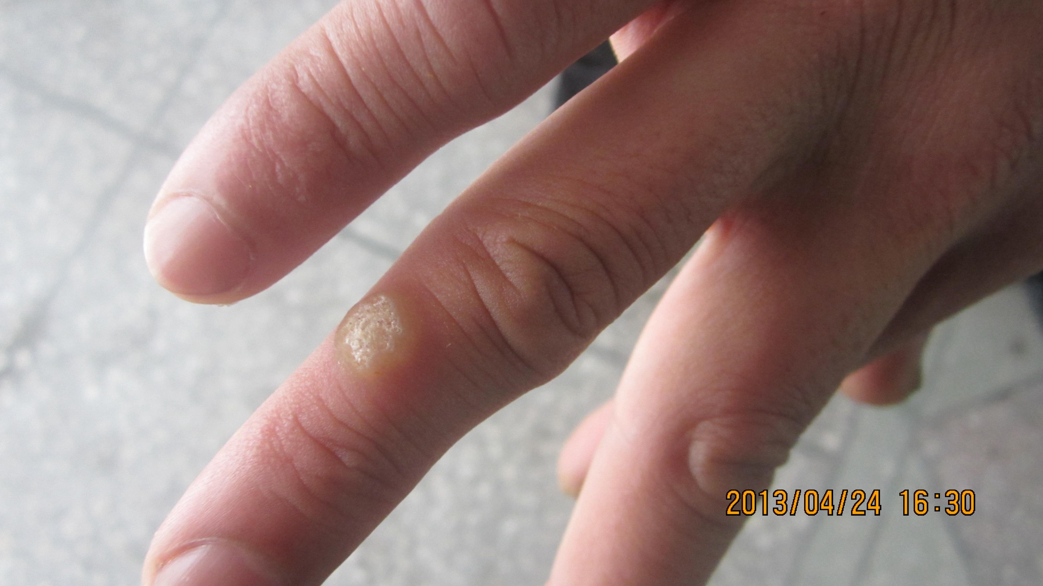 手部皮损出现23年春季皮肤病病例征集