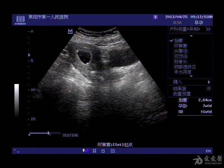 超聲入門貼66宮內節育器下移伴宮內早孕