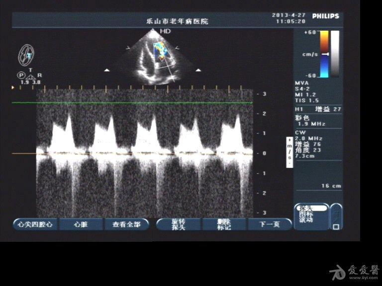 二尖瓣狭窄 超声医学讨论版 爱爱医医学论坛