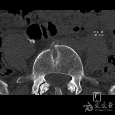蝴蝶椎(ct) - 医学影像学讨论版 - 爱爱医医学论坛