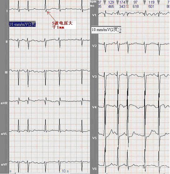 显著电轴左偏心电图jpg