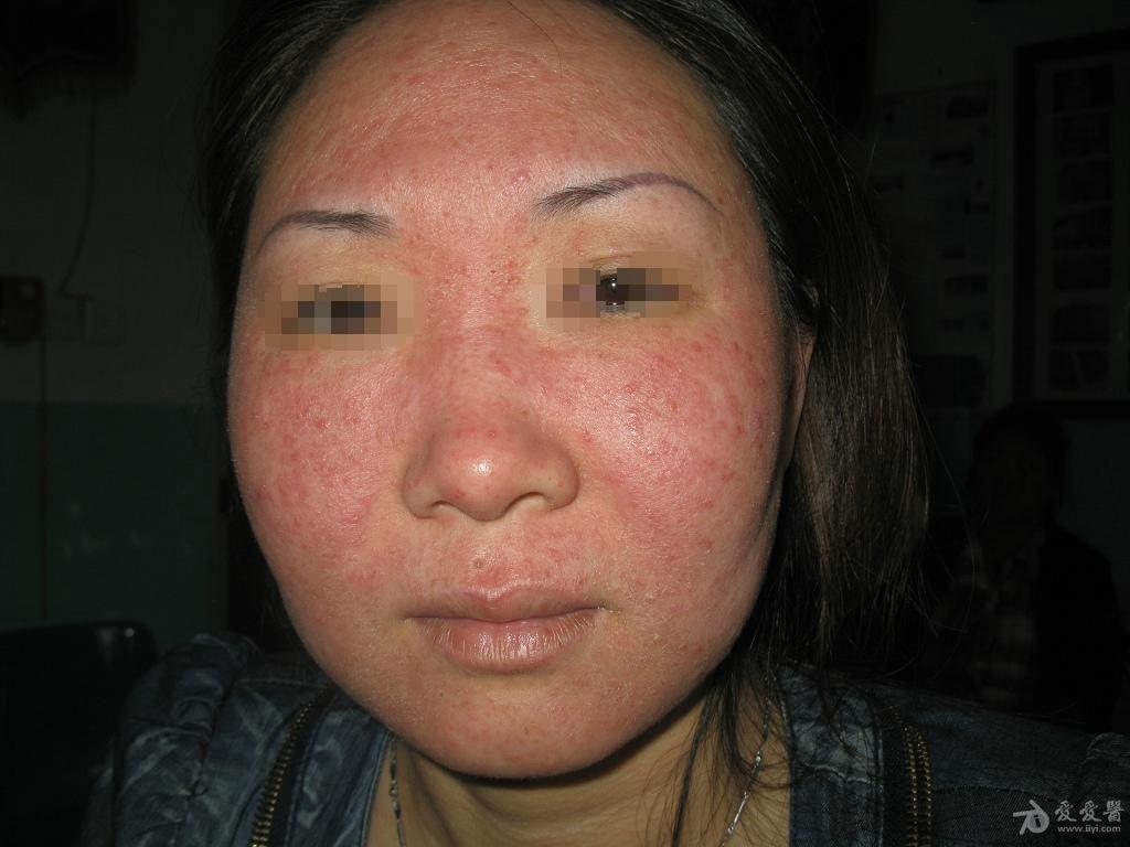 所见最严重的面部蠕型螨皮炎1例