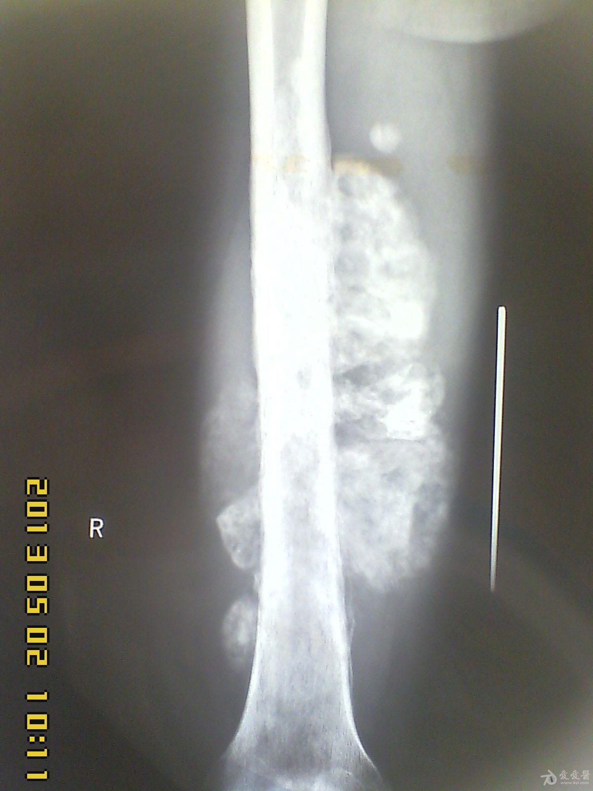 骨肉瘤DR图片图片