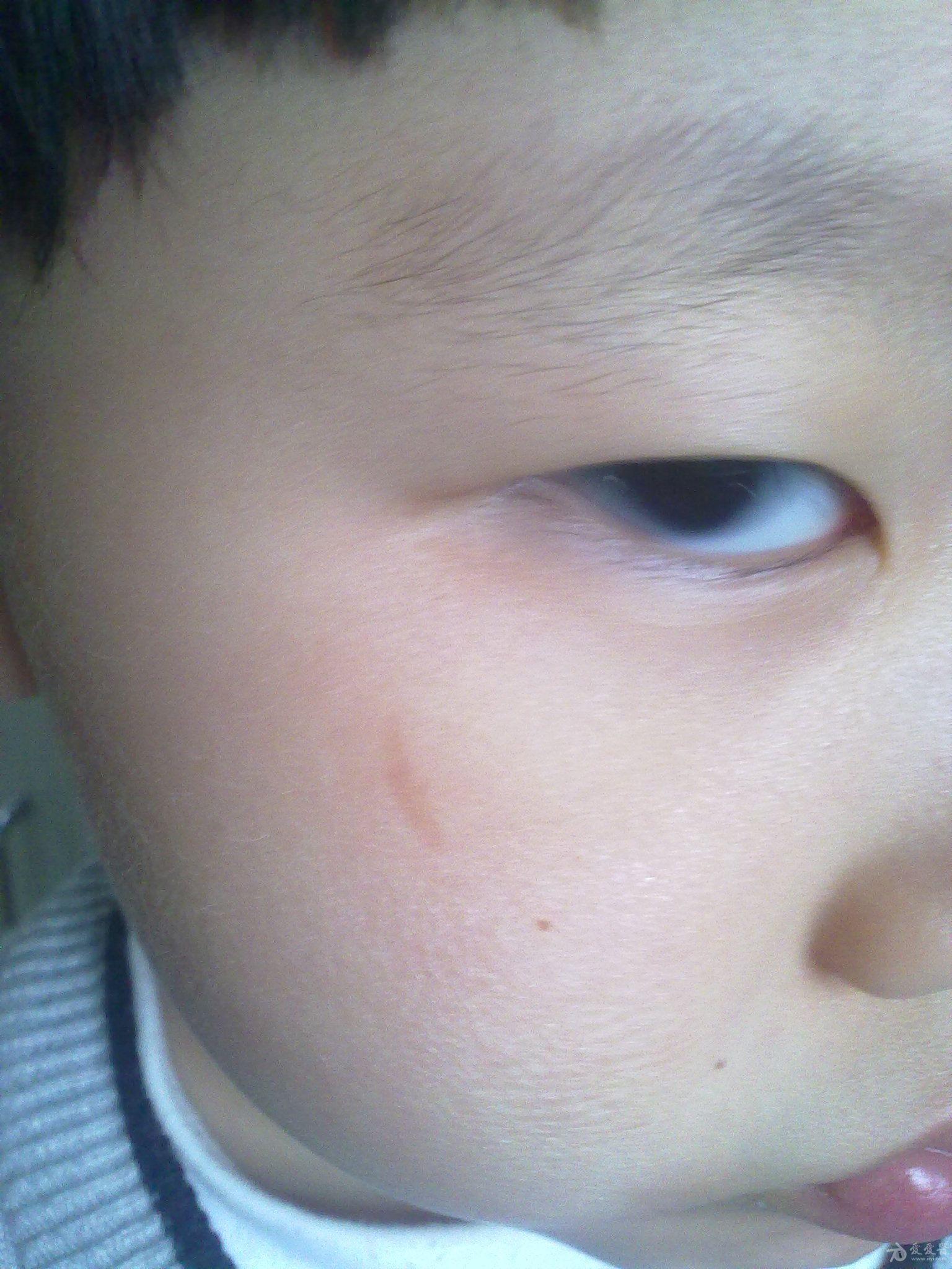 求助其他孩子脸上被抓八个月仍有疤痕