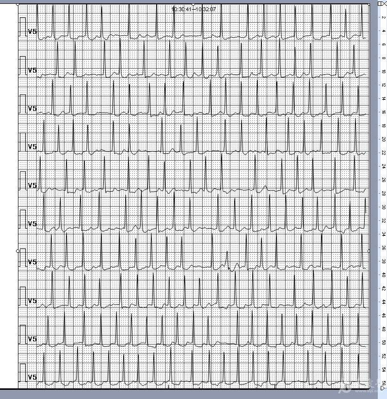 房颤伴室早还是房颤伴差传急求请老师指教
