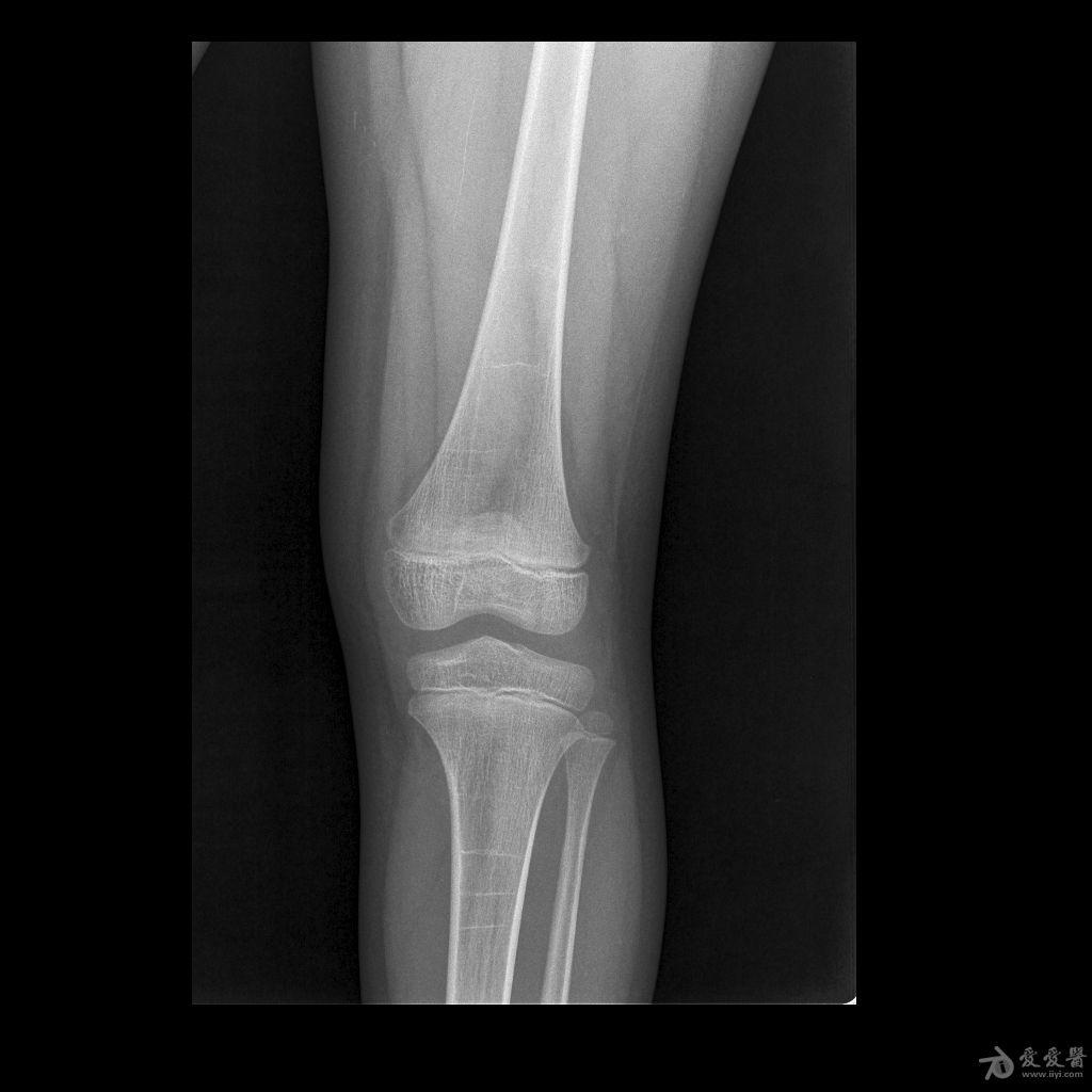 膝关节dr正常片图片