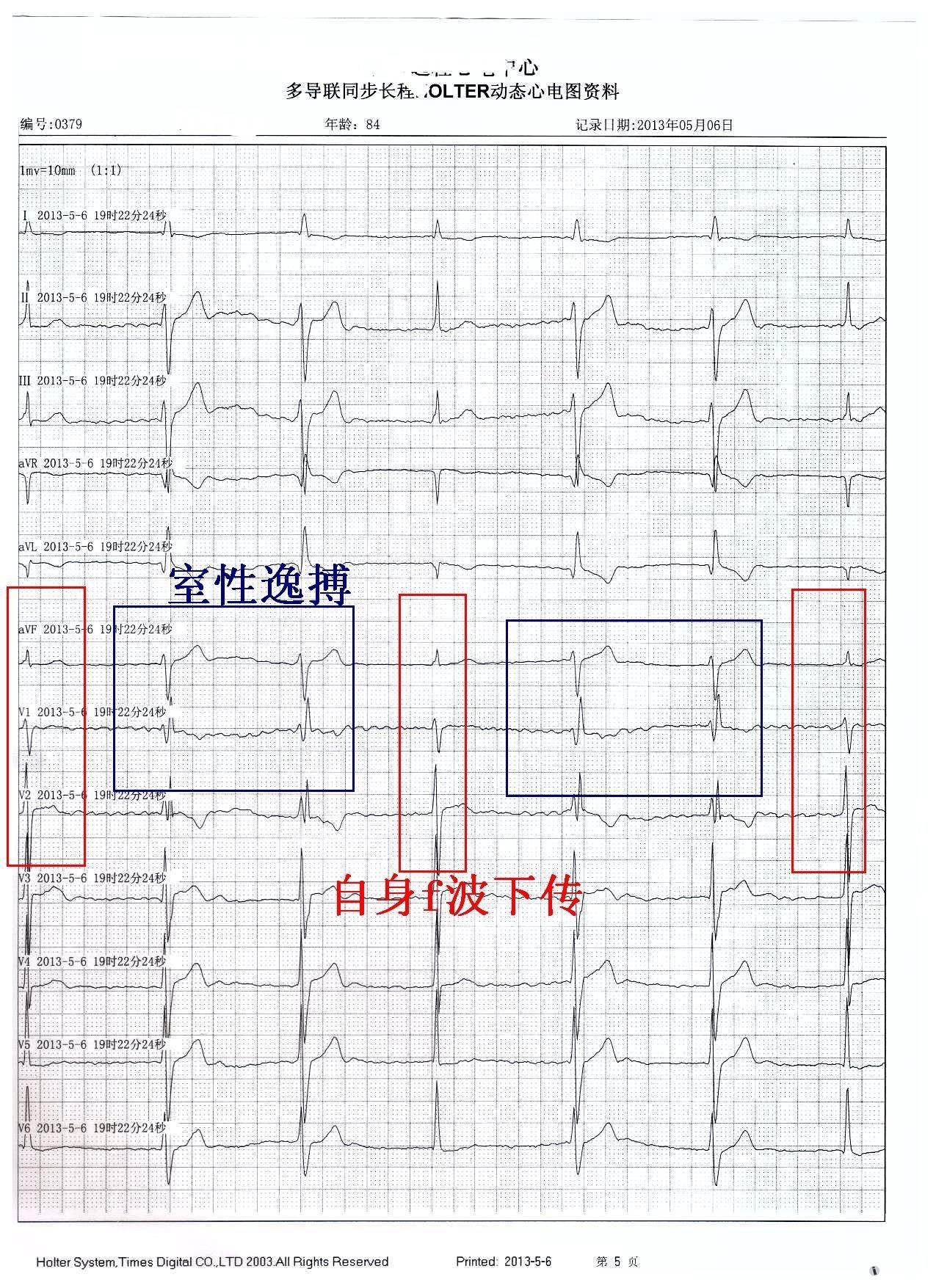 心室逸搏心电图表现图片