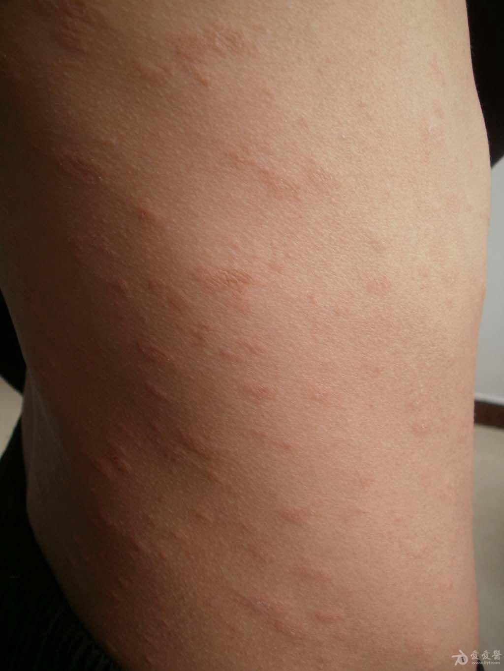 玫瑰糠疹. - 皮肤及性传播疾病讨论版 - 爱爱医医学论坛