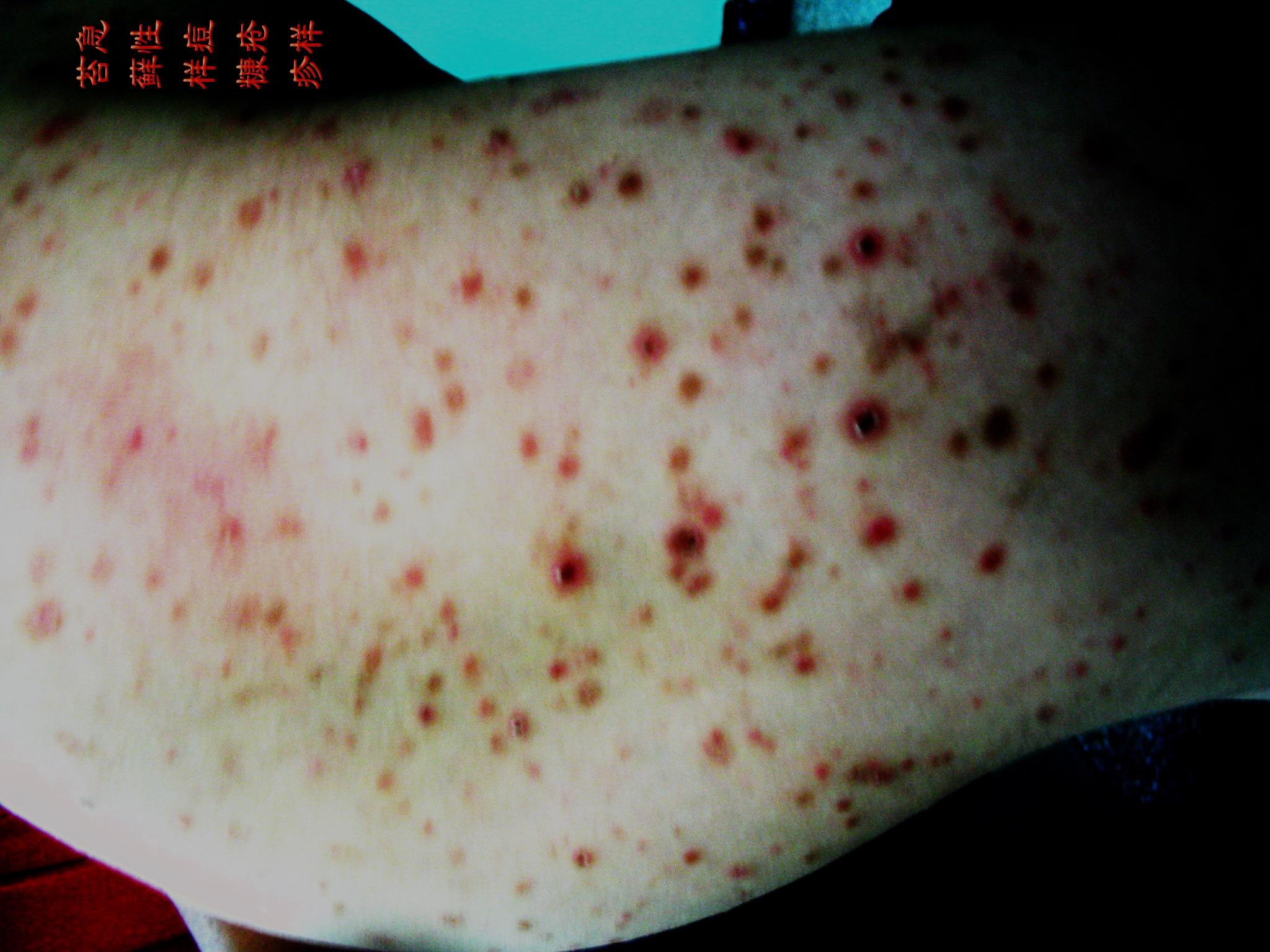 痘疹的症状图片图片