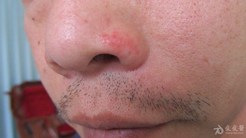 鼻翼耳廓对称的丘疹急性湿疹