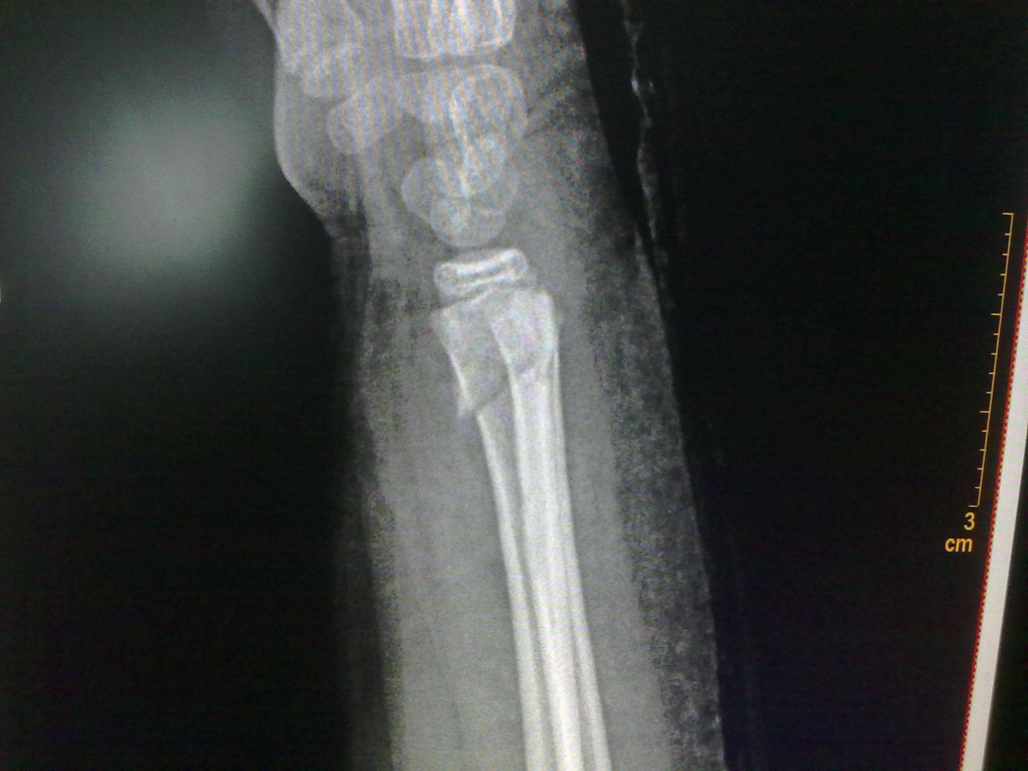 colles骨折手法复位后石膏固定