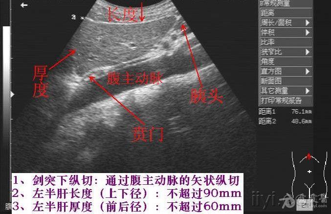 肝脏血管结构及分叶的详细图文解说 - 超声医学讨论版 - 爱爱医医学