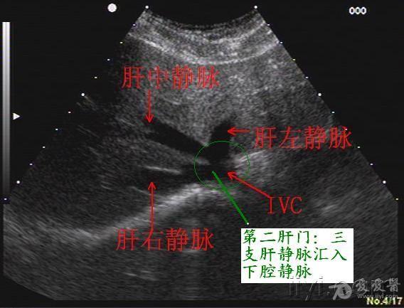 肝脏血管结构及分叶的详细图文解说 - 超声医学讨论版 - 爱爱医医学