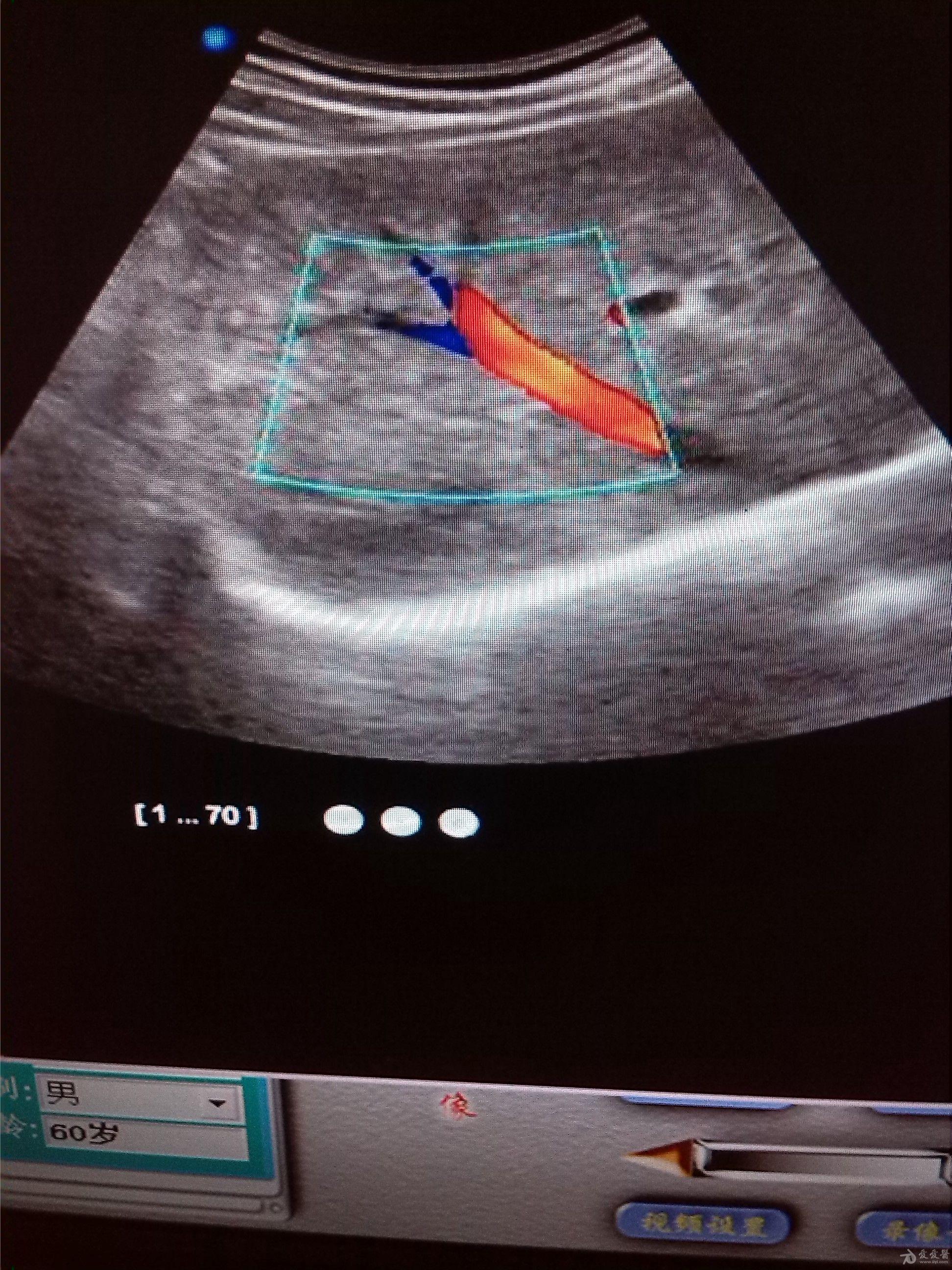 肝内弥漫性血管瘤病一例 - 超声医学讨论版 - 爱爱医医学论坛