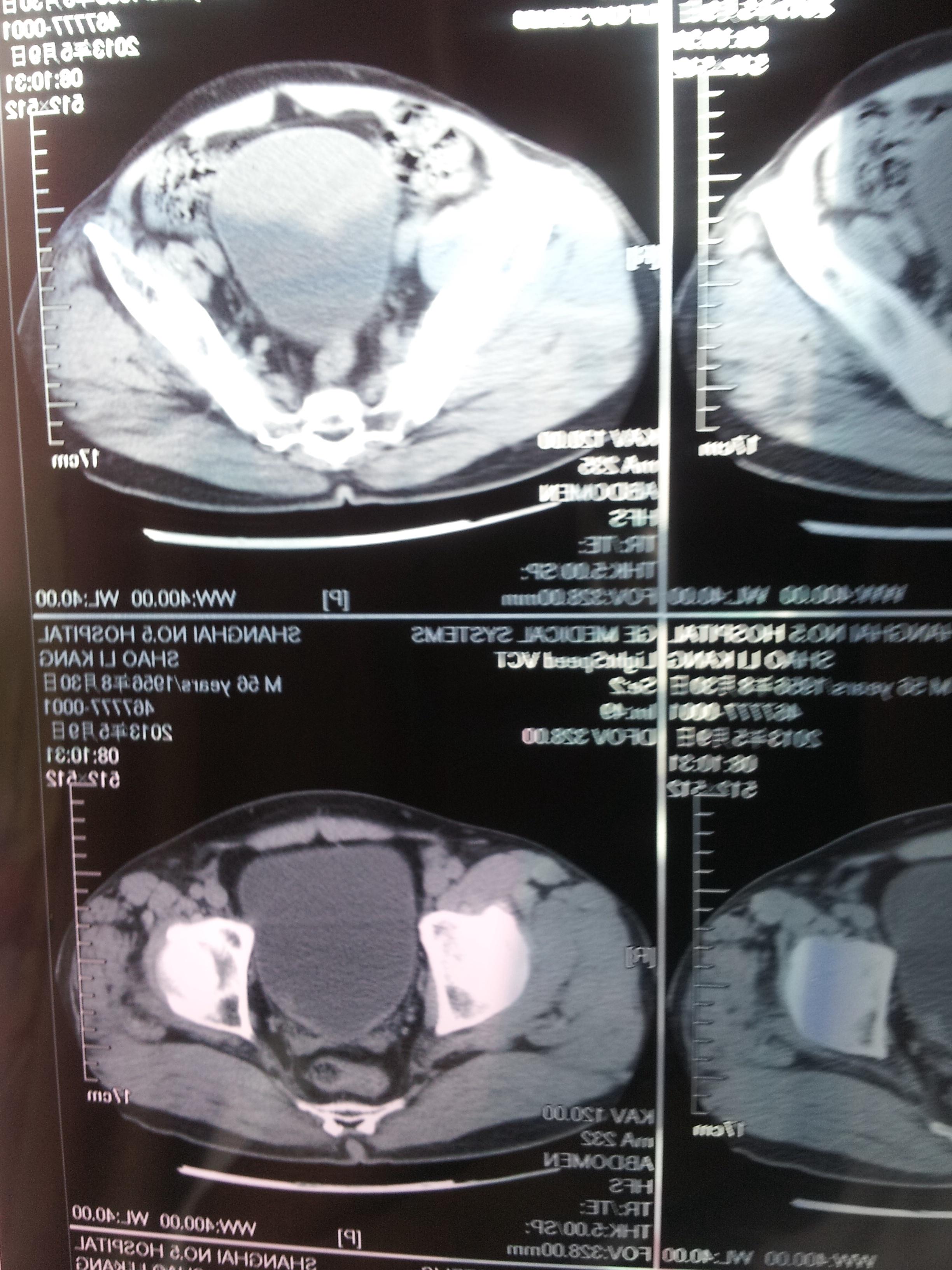 膀胱囊肿CT图片
