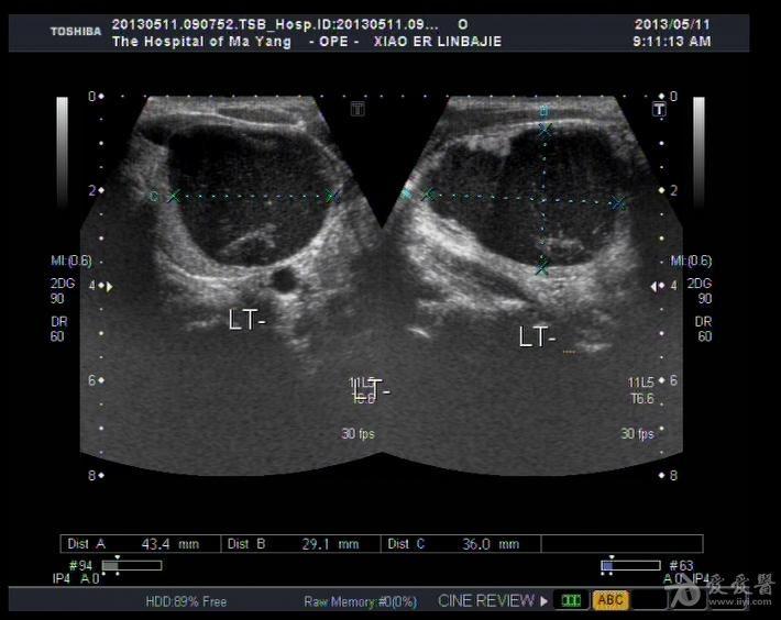 这是甲状腺囊腺瘤吗,求解 超声医学讨论版 爱爱医医学论坛