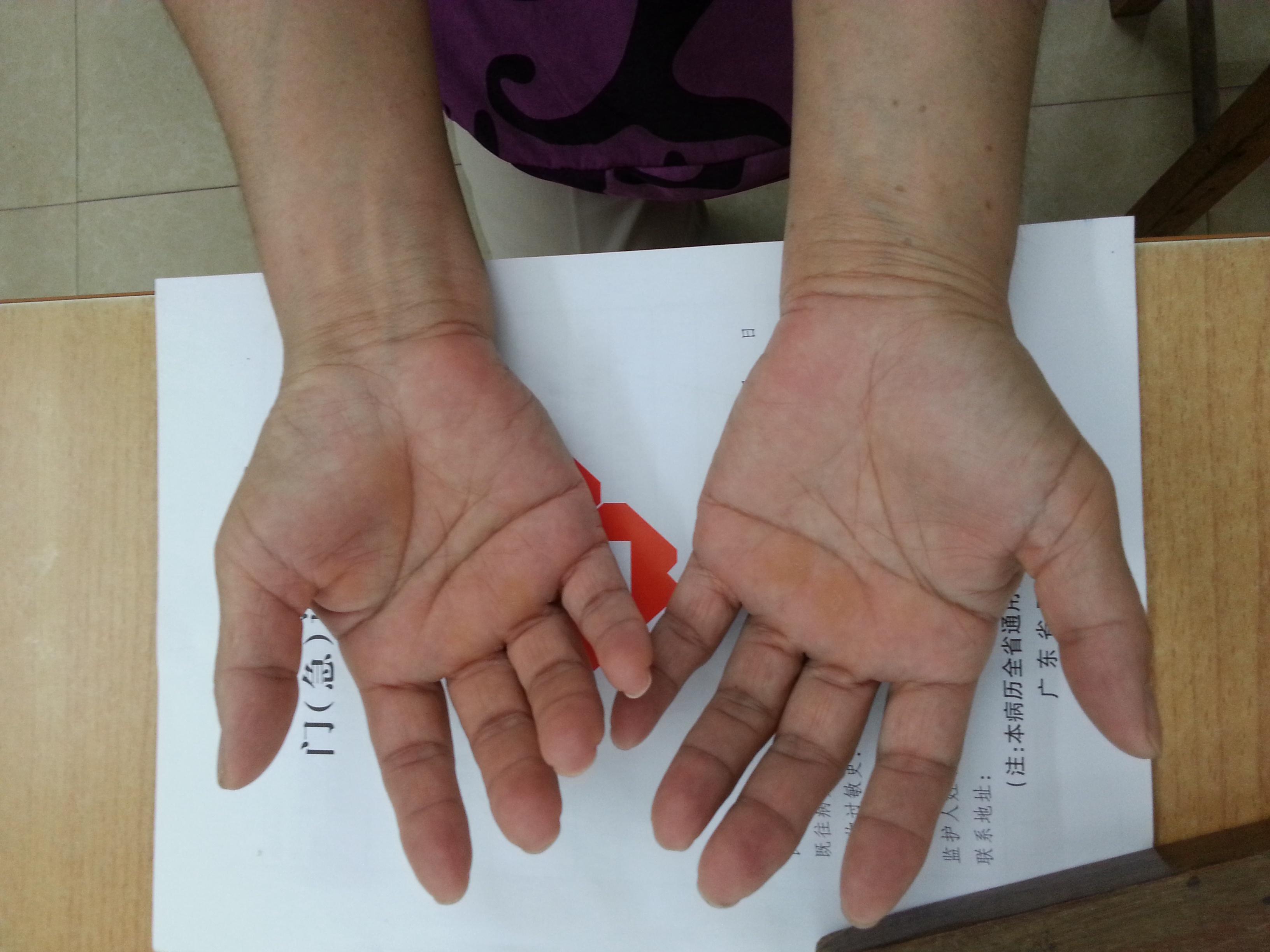 今日门诊见闻双手肌肉萎缩