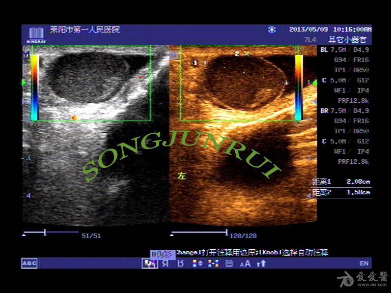 睾丸囊肿超声图片图片