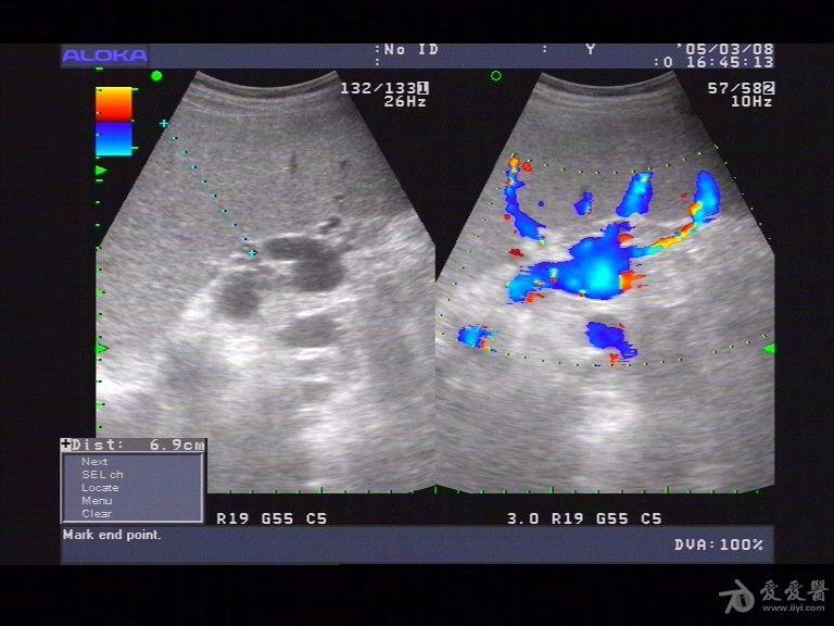 肝硬化伴大量腹水 - 超声医学讨论版 - 爱爱医医学论坛