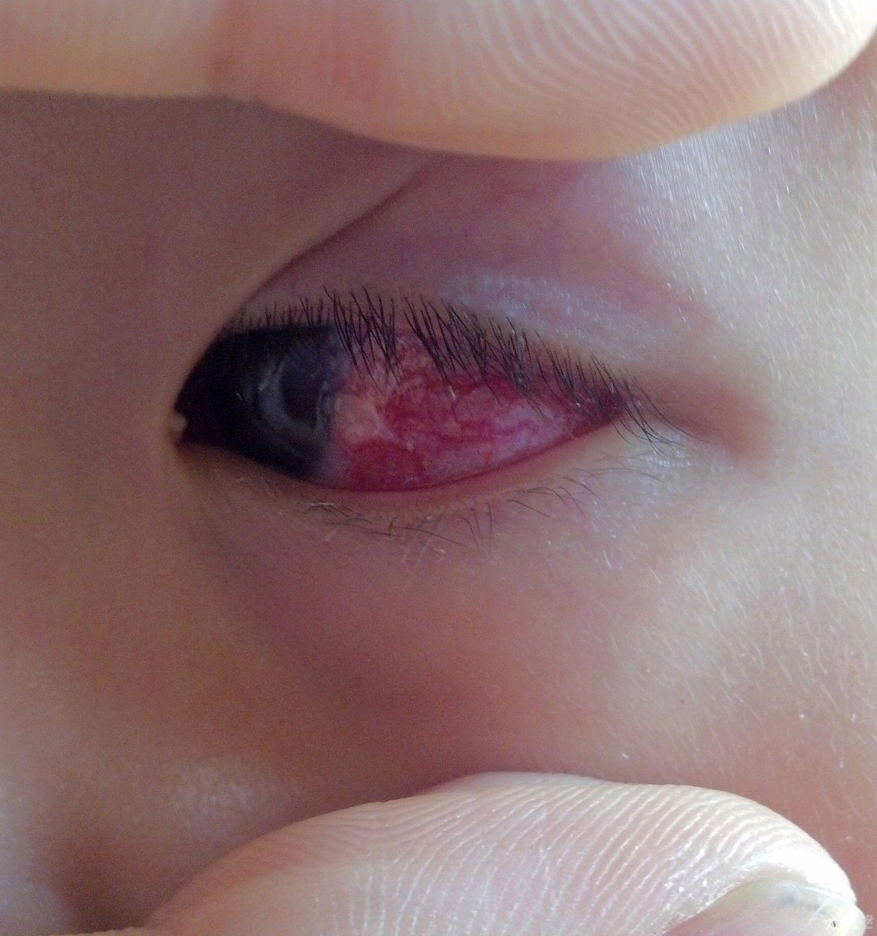 儿童角膜炎的症状图片图片