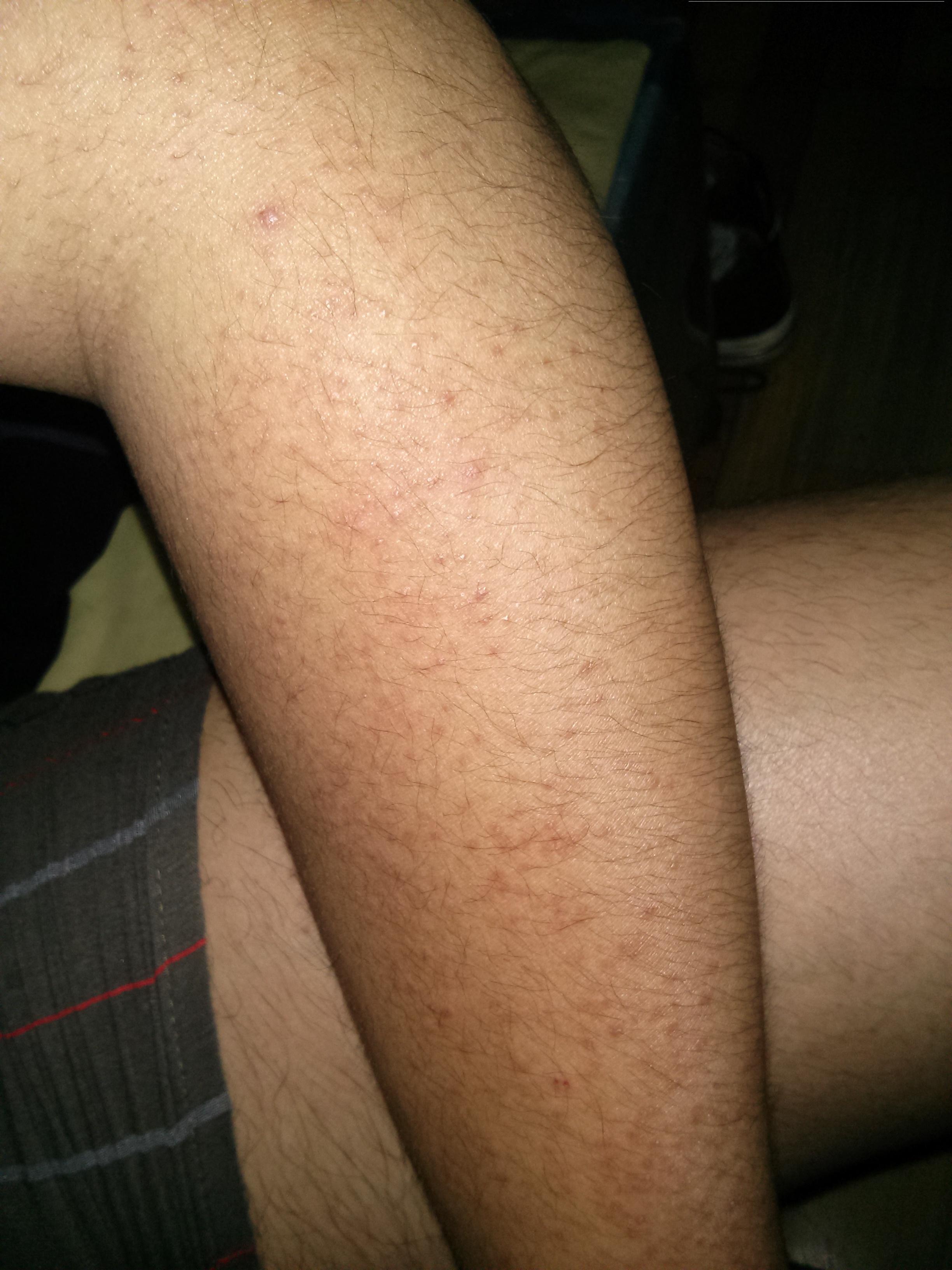 毛周角化症就是鸡皮肤吗(脸部毛周角化症是鸡皮肤吗) 毛周角化症就是鸡皮肤吗(脸部毛周角化症是鸡皮肤吗)