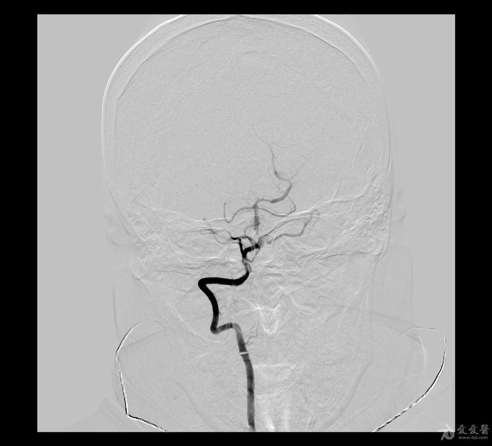 一例年轻女性多发脑血管狭窄的介入治疗案例