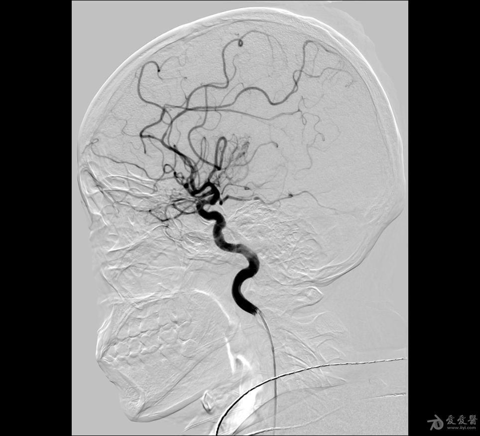 一例年轻女性多发脑血管狭窄的介入治疗案例