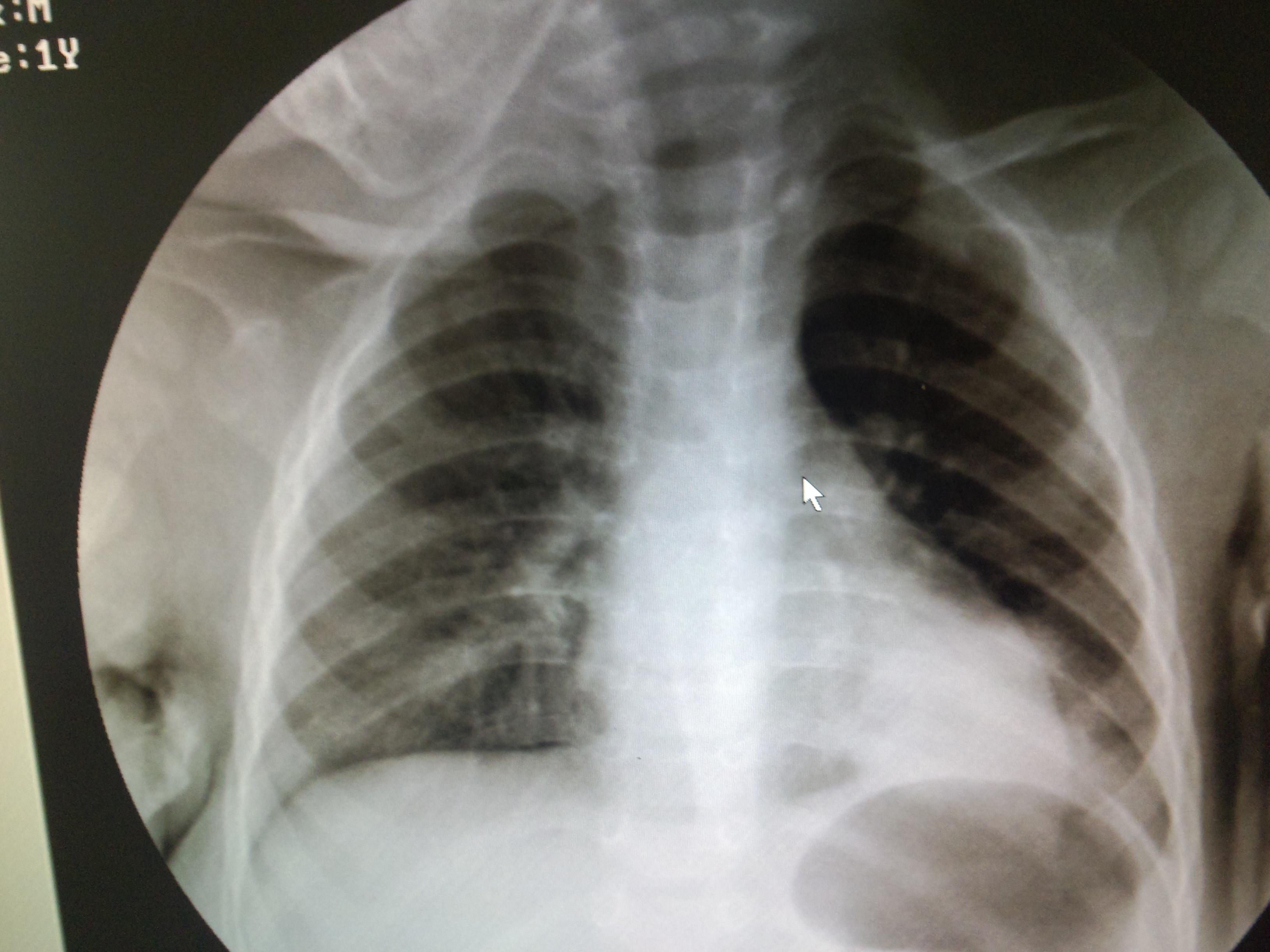 肺炎胸片儿童图片