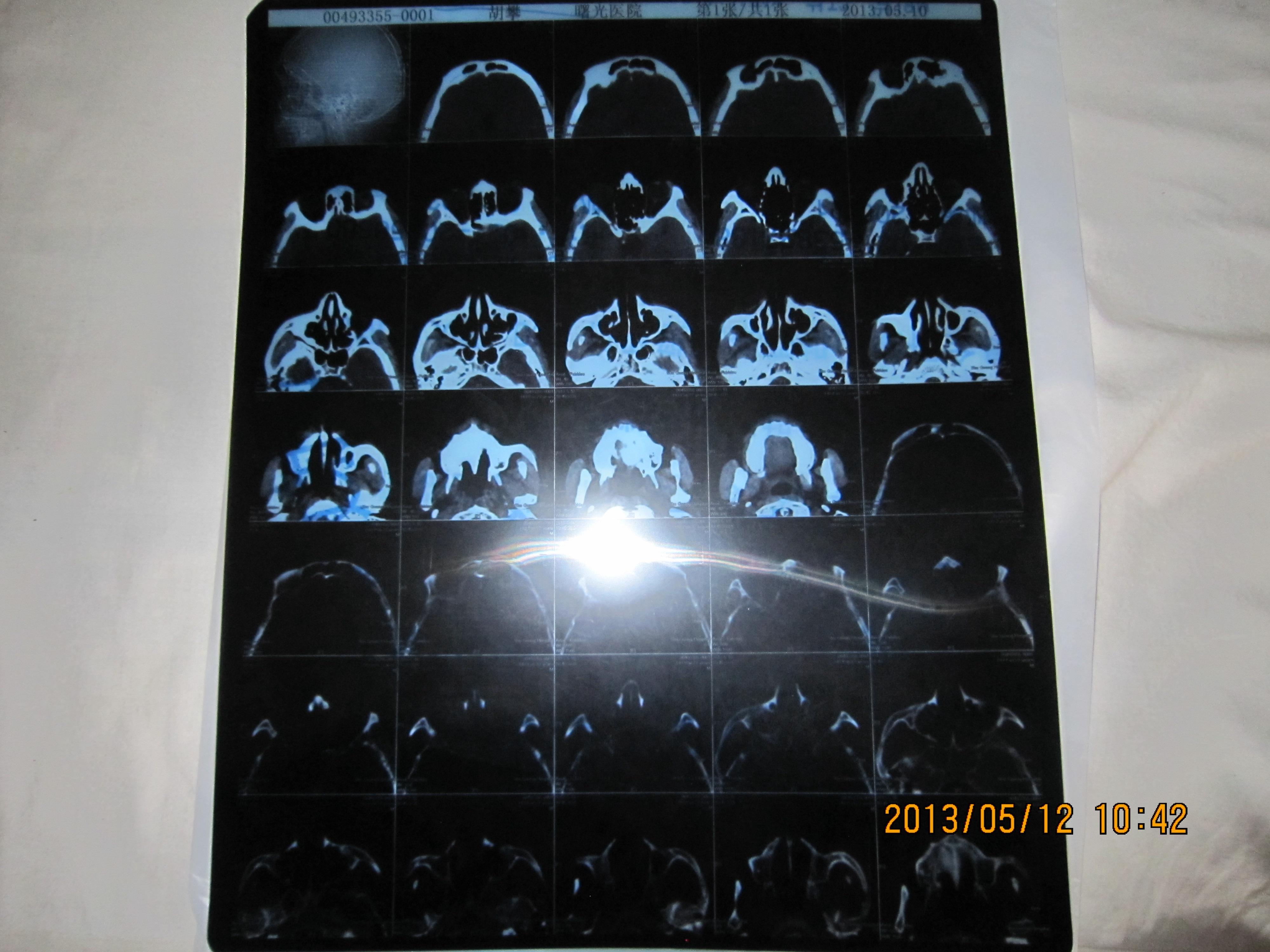 额骨骨瘤ct图片图片
