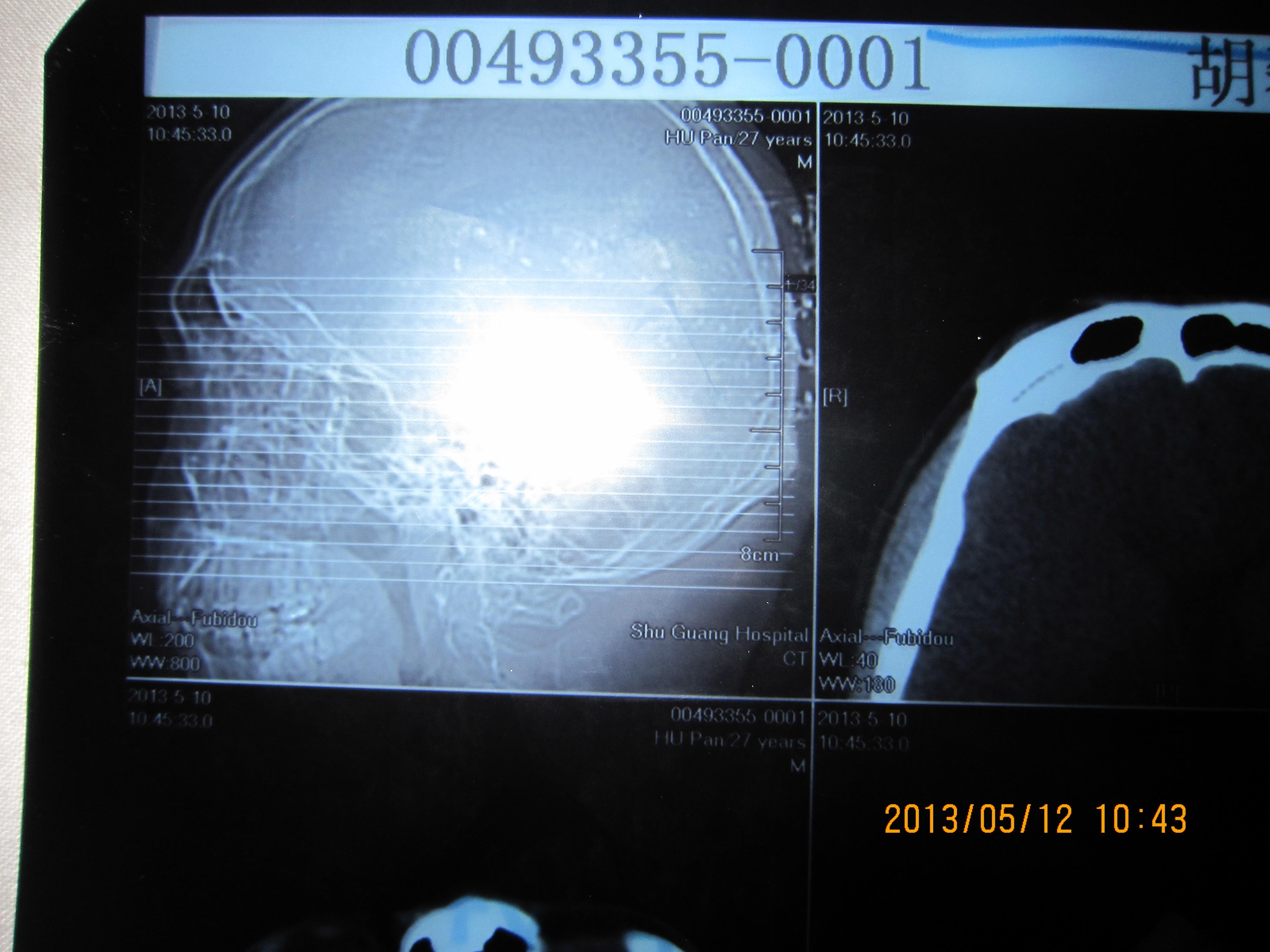 额骨骨瘤ct图片
