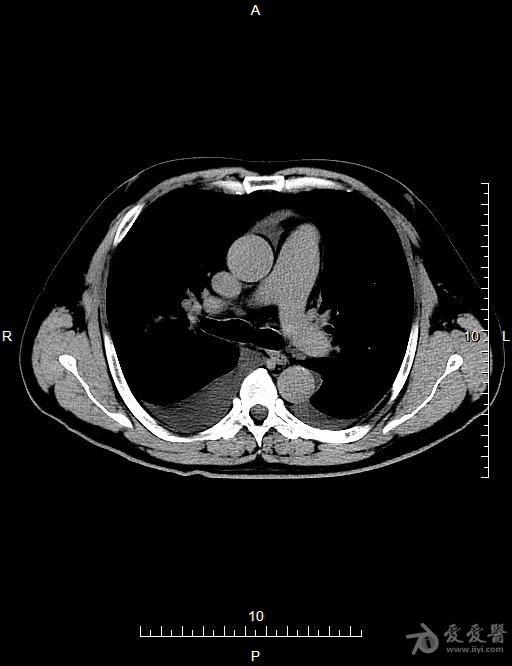 胸部ct请会诊