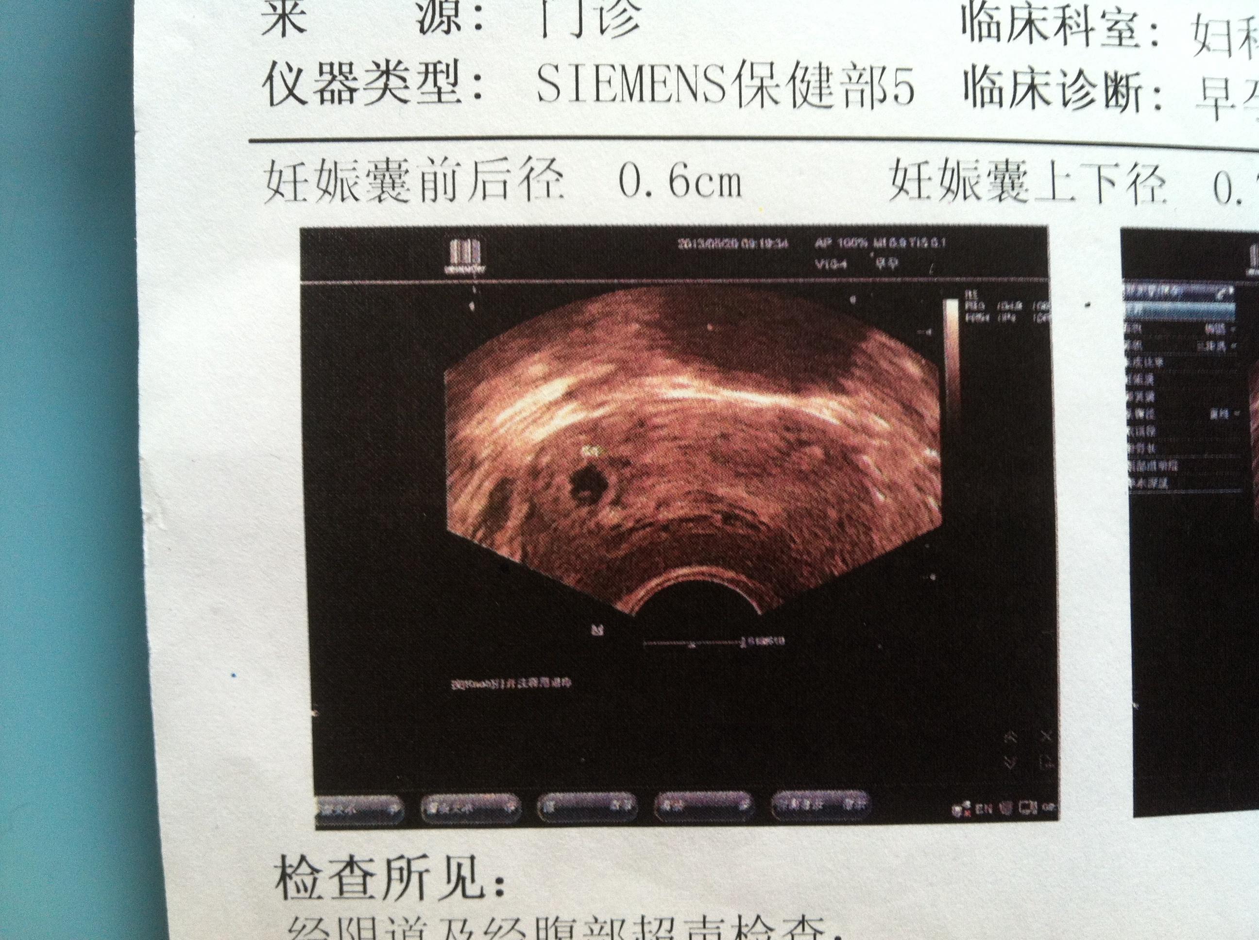 请各位帮忙看是否为部分性葡萄胎?