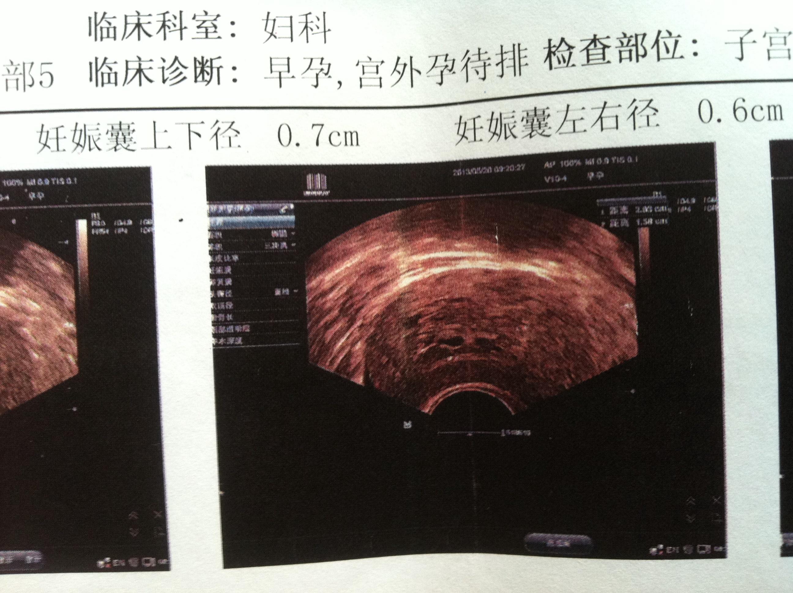 請各位幫忙看是否為部分性葡萄胎?