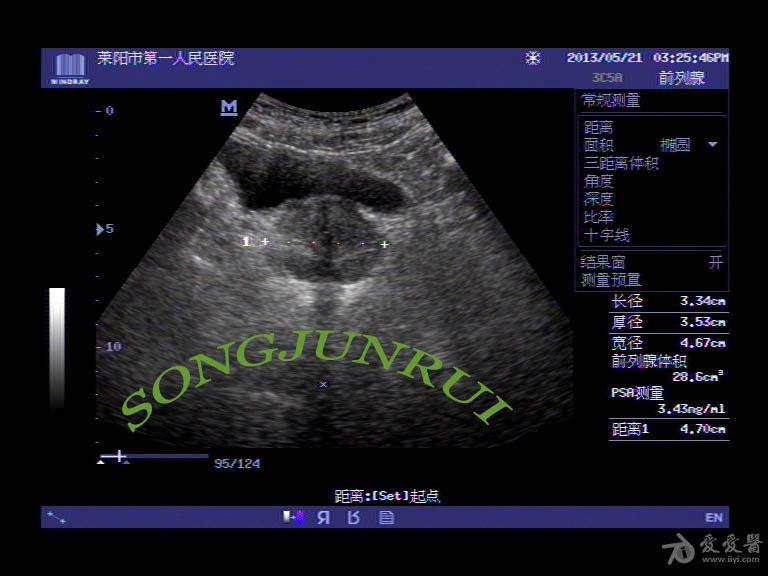 超声入门贴70-----前列腺测量方法