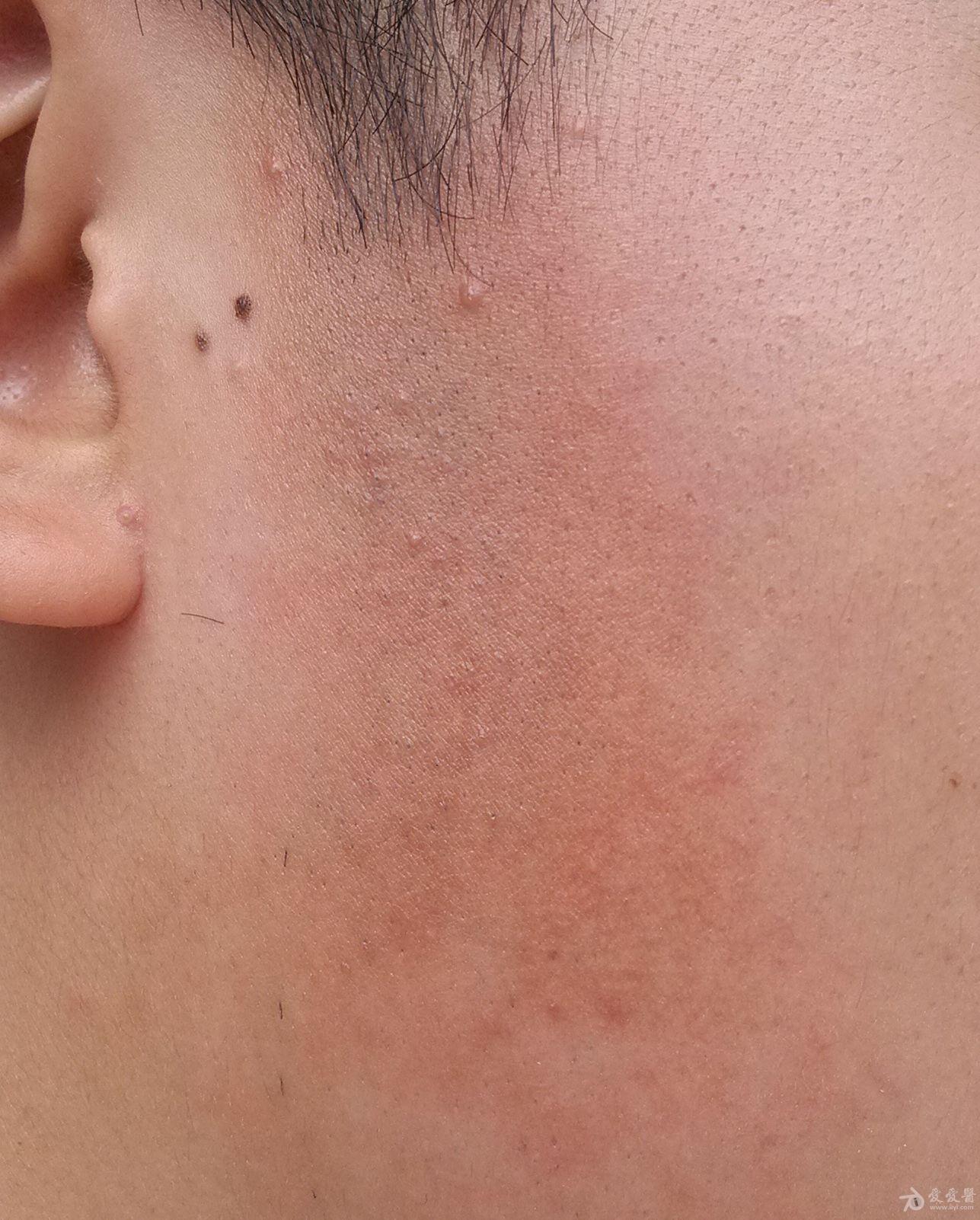 面部斑痕大家帮忙诊断下