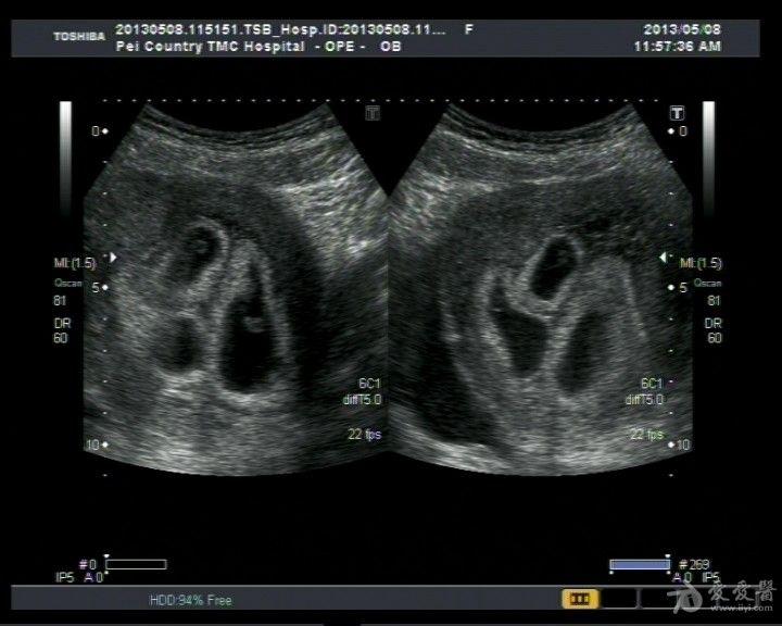 患者子宫腺肌症并多胎妊娠