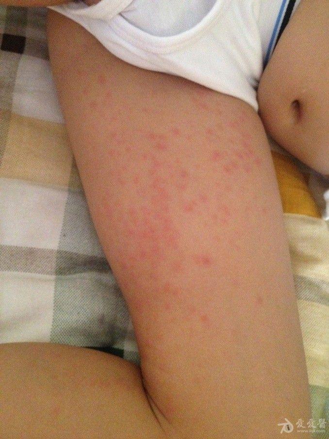 4岁小孩大腿内侧发的红疹是什么