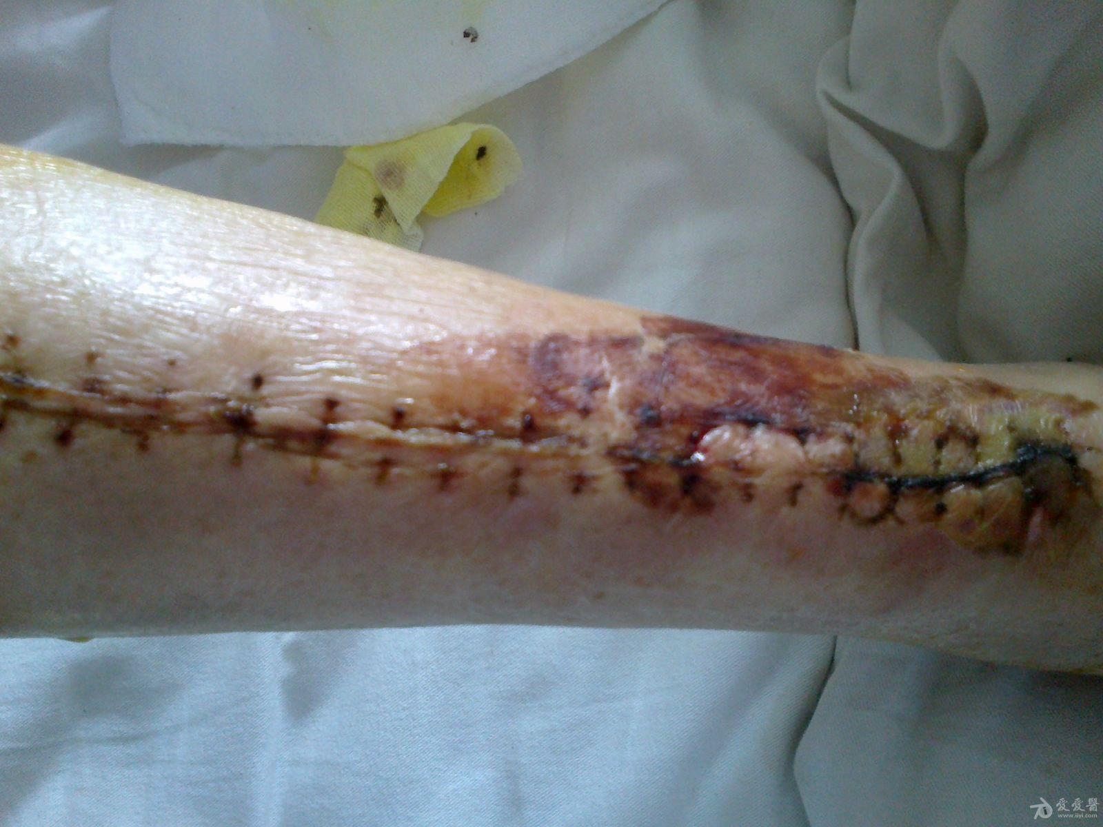 糖尿病患者术后伤口愈合不佳