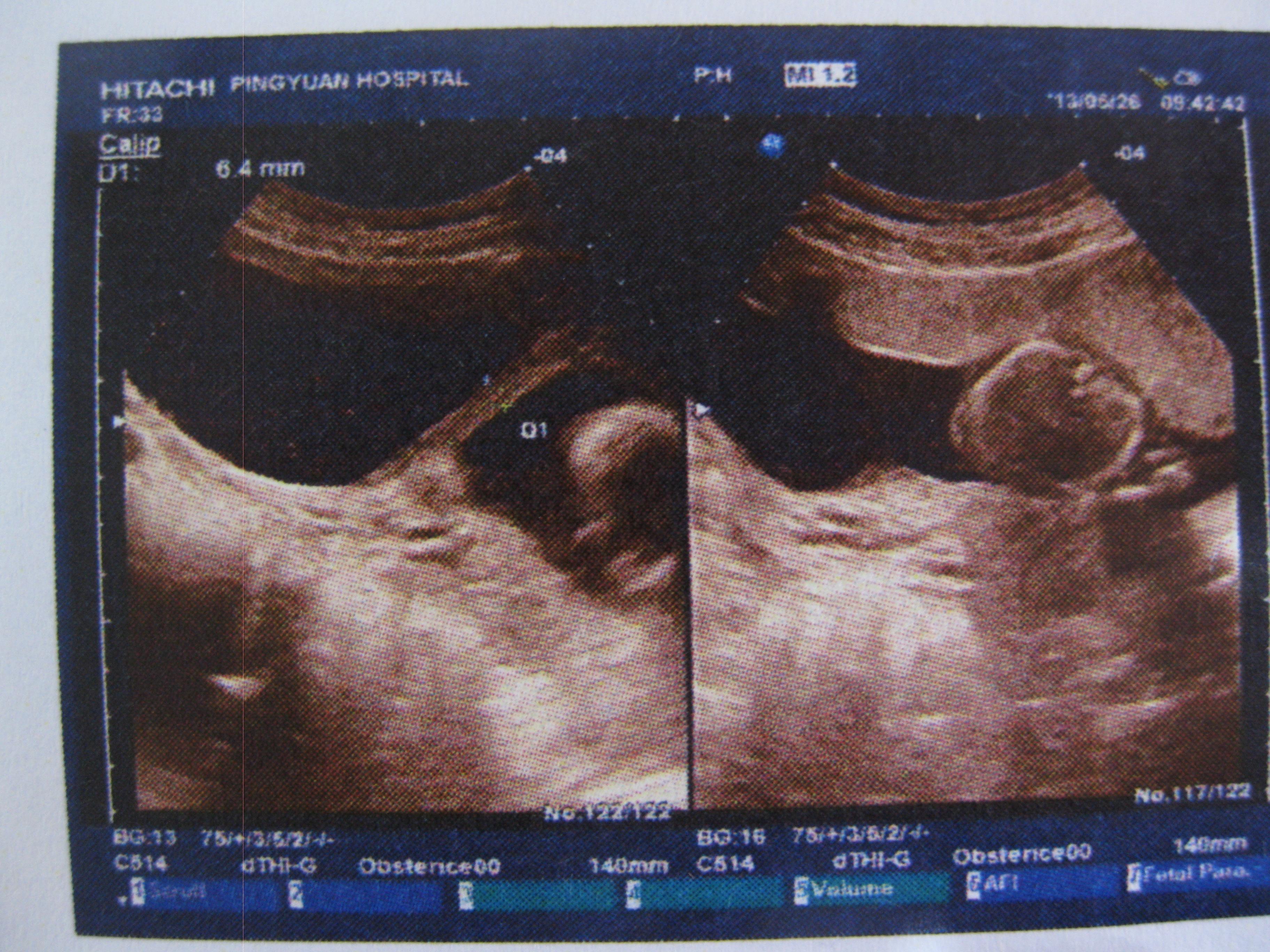 (宫腔粘连?羊膜片?