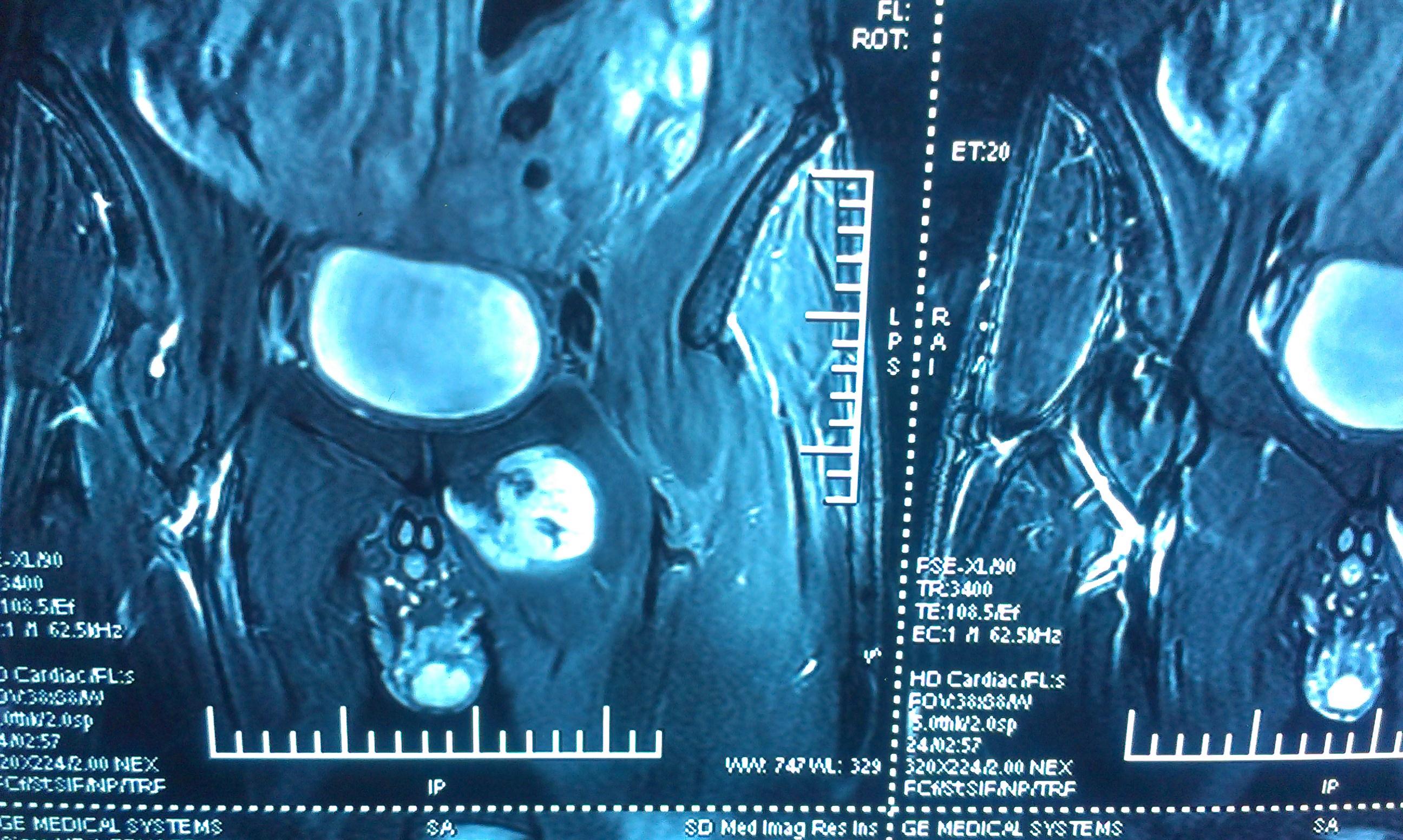 腹股沟恶性肿瘤图片