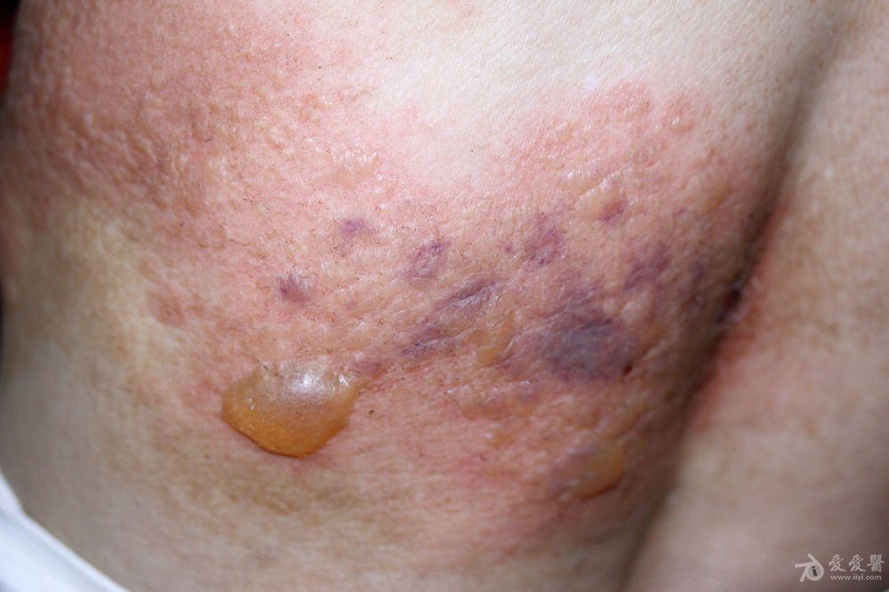 带状疱疹女性早期症状图片