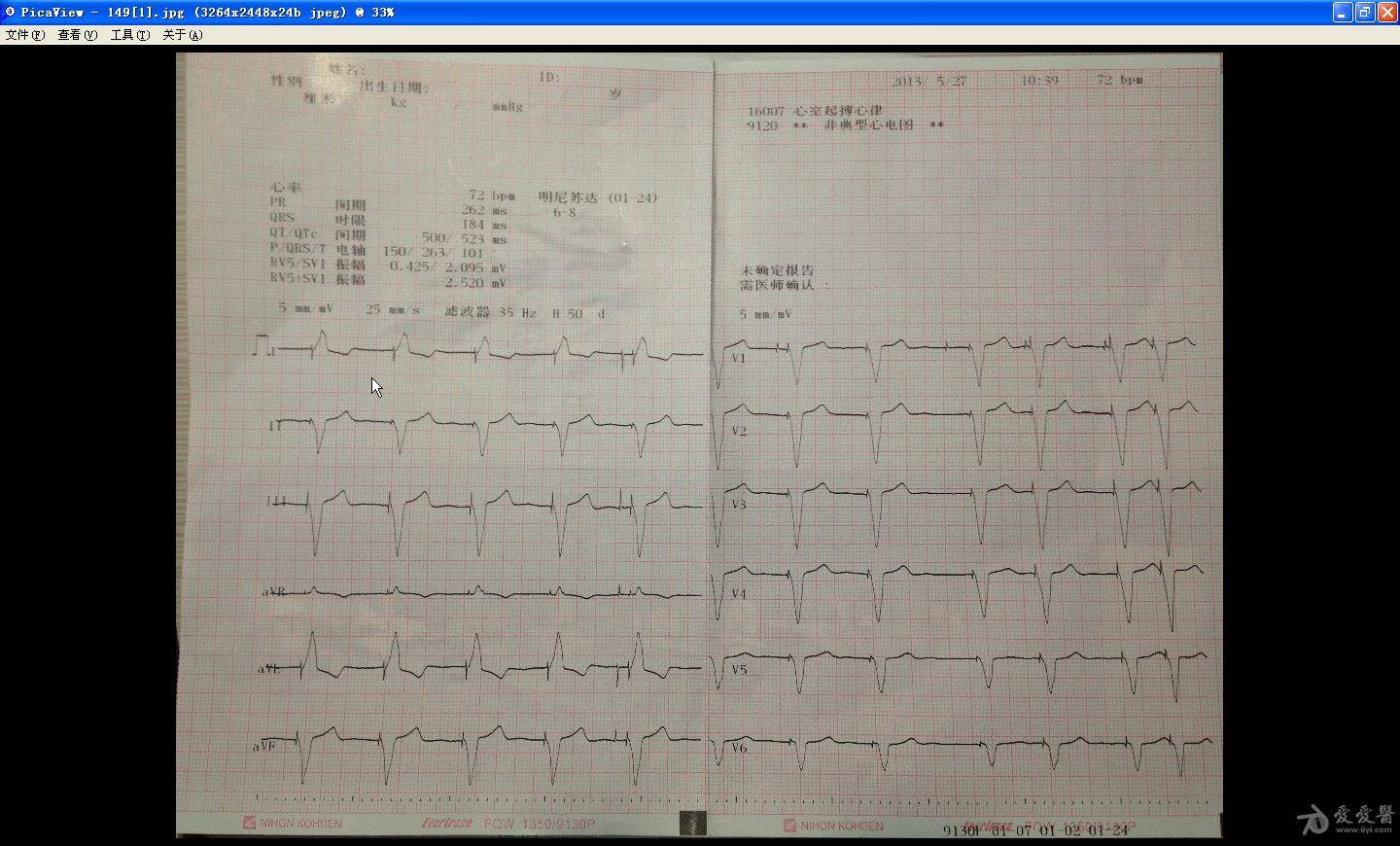 心脏起搏器心电图报告图片