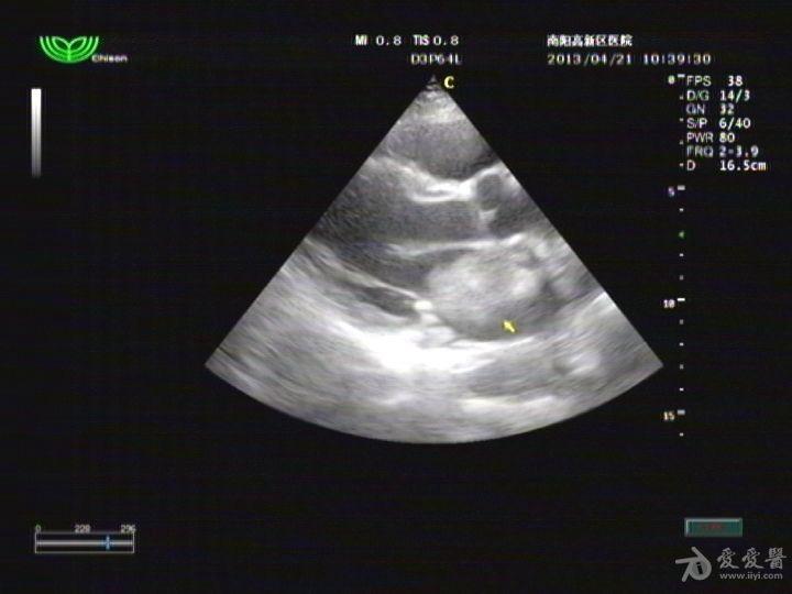 心脏粘液瘤超声图片