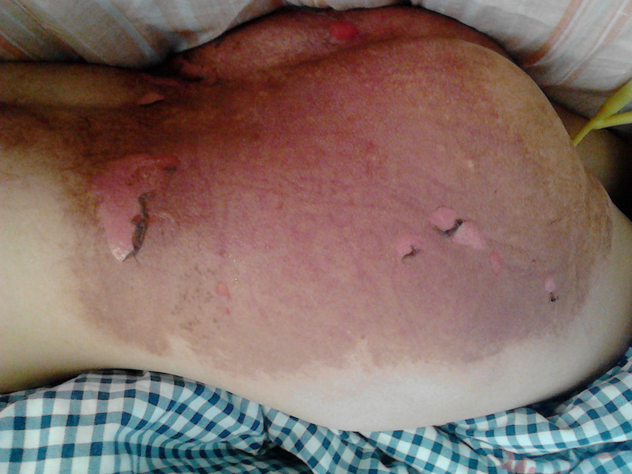 接触皮炎还是剥脱性皮压或者是压疮