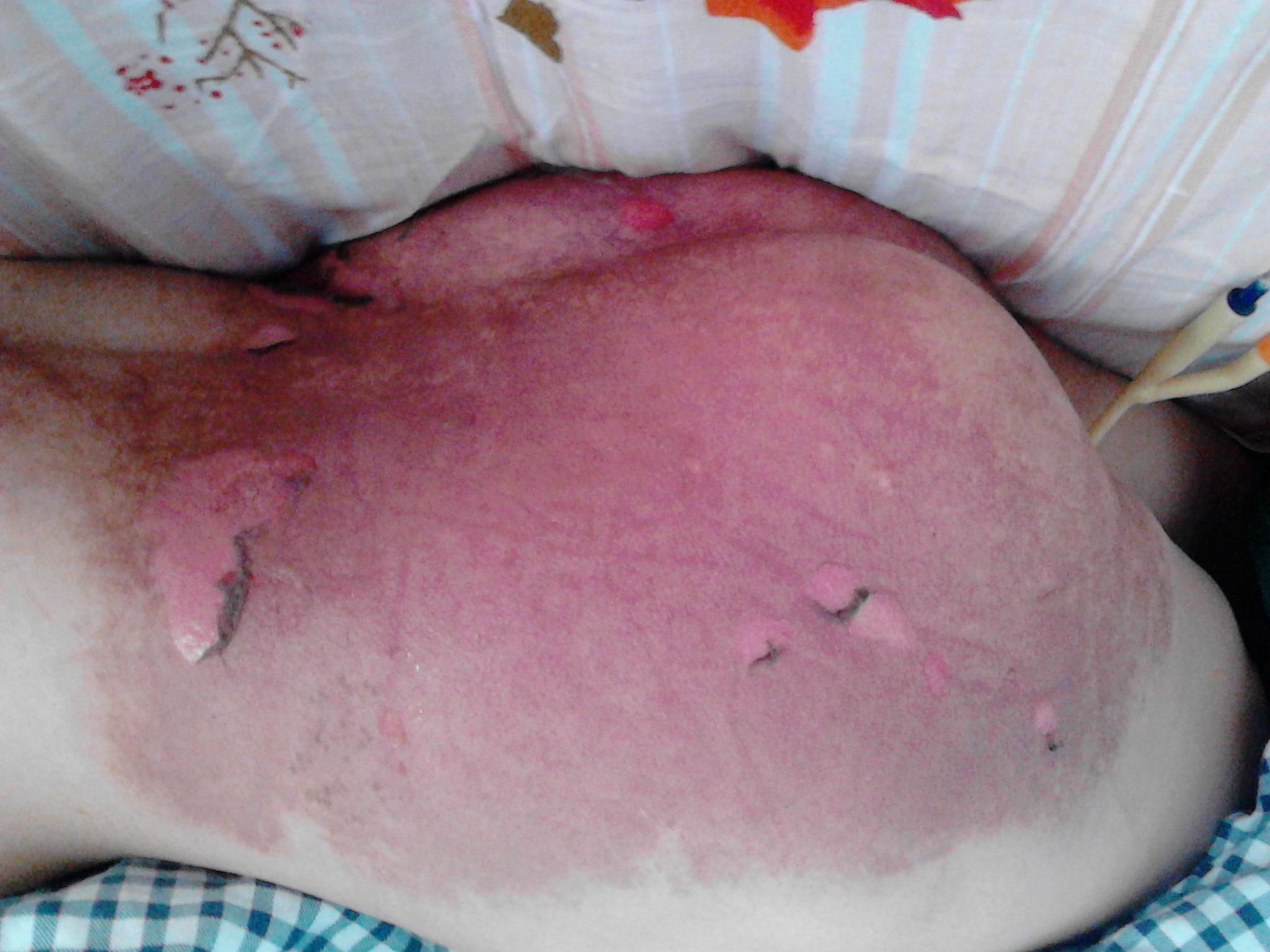 接触皮炎还是剥脱性皮压或者是压疮