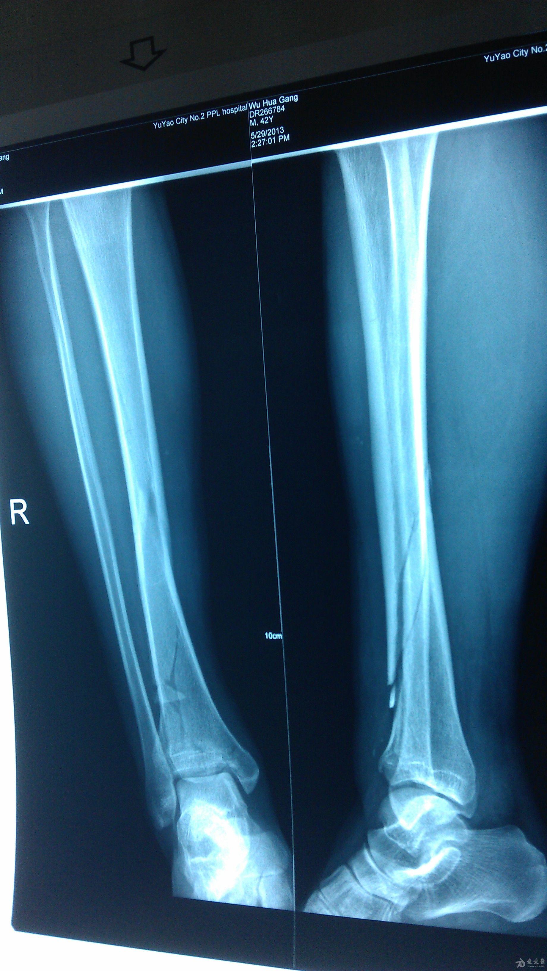 左胫骨远端骨折图片图片