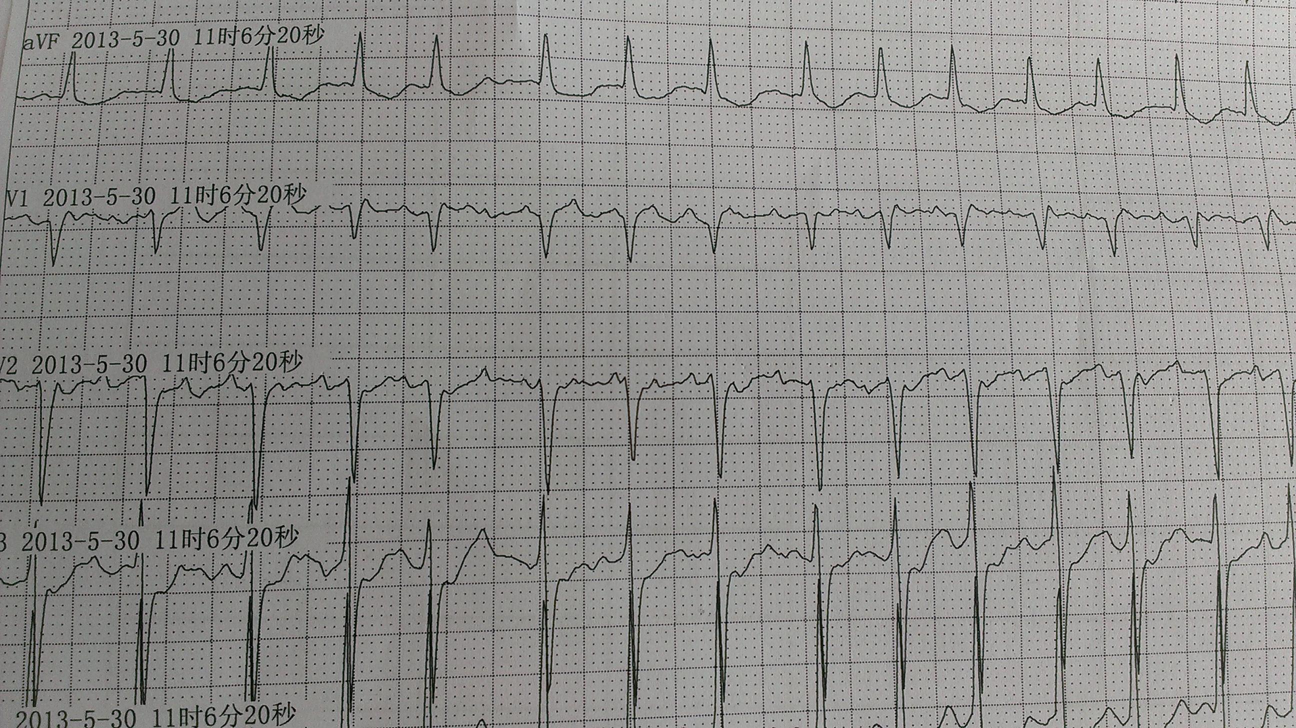 陣發性房撲或房速,糾結 - 心電圖腦電圖專業討論版 - 愛愛醫醫學論壇