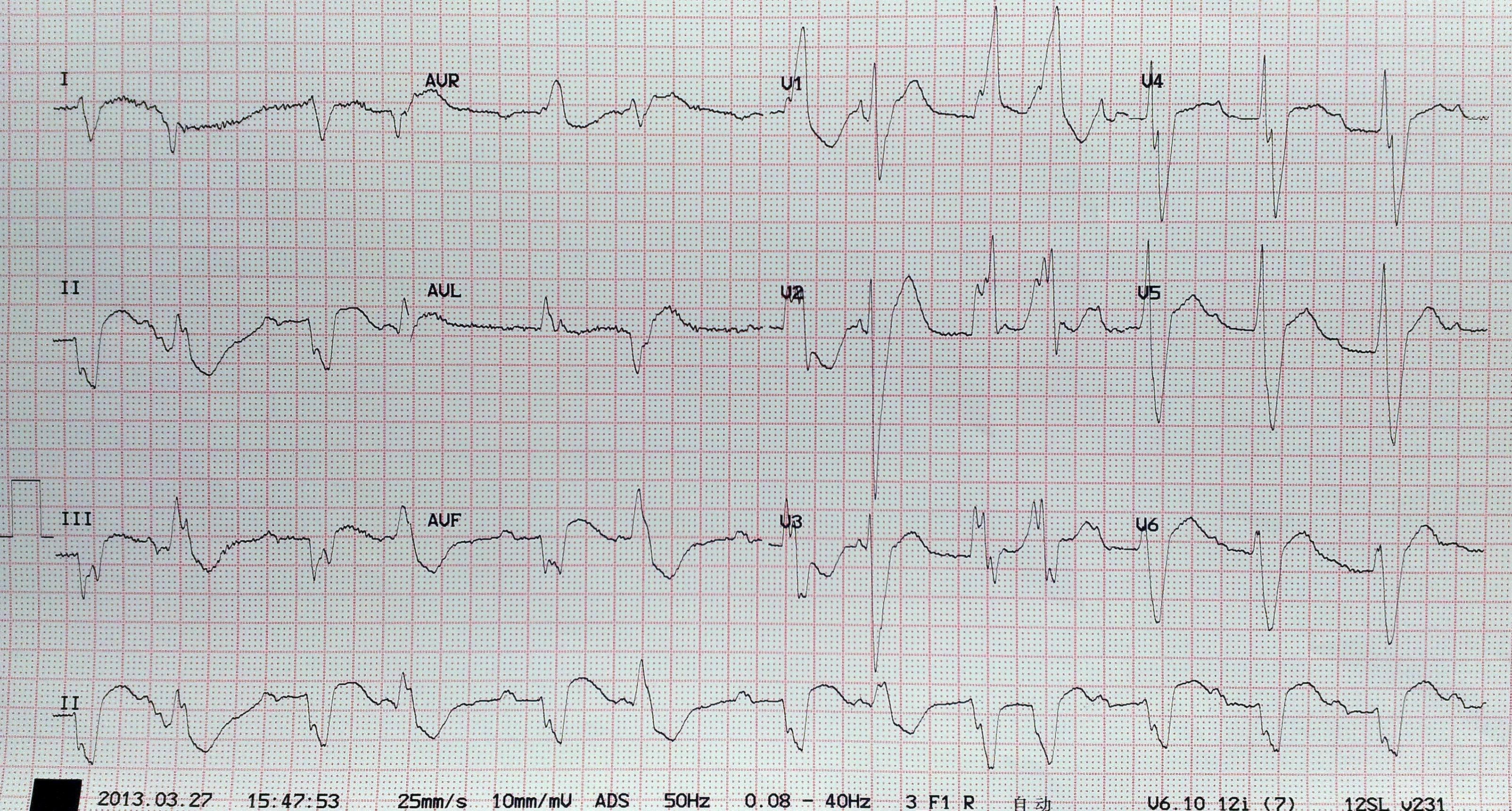 急性心包积液心电图图片
